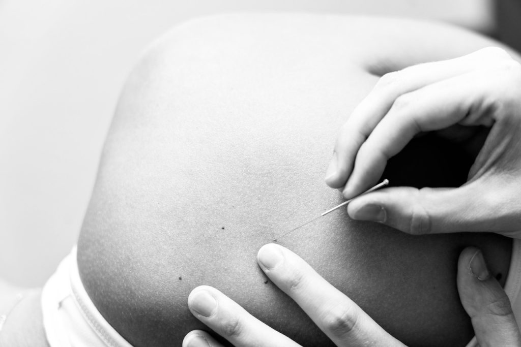 Dry needling en kinesitherapie